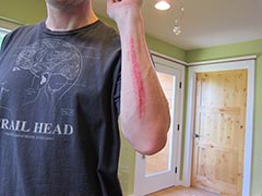 my forarm with a nice scrape after brushing a tree mountain biking